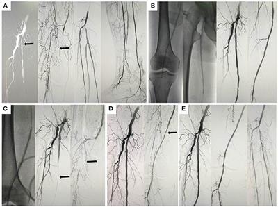 Case report: Unusual persistent hypotension and acute occlusion after peripheral paclitaxel balloon angioplasty